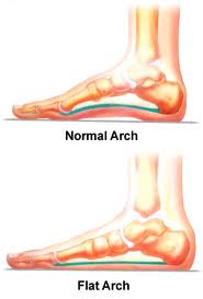 MR Podiatry flat feet arch